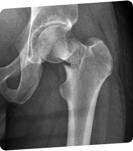 X-ray of a femur and pelvis joint